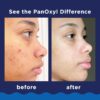 PanOxyl Acne Foaming Wash Benzoyl Peroxide 10% Maximum Strength